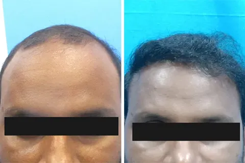 Hair rejuvation therapy before photo in VCare